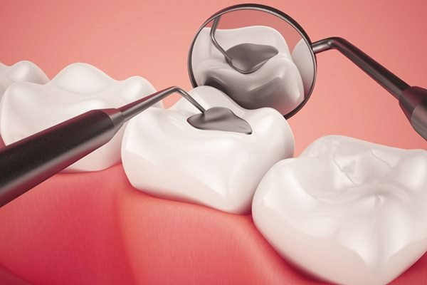 Giải pháp trám răng tốt nhất 2024 mà cộng đồng Tdentist khuyên bạn là gì? Nụ cười rạng rỡ là điểm cộng lớn cho nhan sắc và sự tự tin của mỗi người. Tuy nhiên, răng sứt mẻ, vỡ, mòn do tai nạn, sâu răng,... ảnh hưởng đến thẩm mỹ và chức năng ăn nhai. Trám răng là giải pháp nha khoa hiệu quả giúp phục hồi răng, cải thiện nụ cười và nâng cao chất lượng cuộc sống. Bài viết này sẽ cung cấp thông tin chi tiết về: •	Lợi ích của trám răng:  o	Phục hồi thẩm mỹ: Trám răng giúp che đi những khuyết điểm của răng, mang lại nụ cười rạng rỡ và tự tin hơn. o	Bảo vệ răng: Trám răng giúp bảo vệ phần tủy răng khỏi vi khuẩn xâm nhập, ngăn ngừa sâu răng và các bệnh lý nha khoa khác. o	Cải thiện chức năng ăn nhai: Trám răng giúp phục hồi hình dạng và chức năng của răng, giúp bạn ăn nhai dễ dàng và thoải mái hơn. o	Tiết kiệm chi phí: Trám răng là giải pháp tiết kiệm chi phí hơn so với các phương pháp phục hồi răng khác như bọc răng sứ, cấy ghép implant. •	Tại sao phải trám răng:  o	Răng sứt mẻ, vỡ, mòn do tai nạn, va đập. o	Sâu răng ở giai đoạn nhẹ, chưa ảnh hưởng đến tủy răng. o	Khe hở giữa các răng. o	Mòn cổ răng do chải răng sai cách. •	Phương pháp trám răng tốt nhất 2024: Theo cộng đồng Tư vấn Hỏi đáp Nha khoa Tdentist, phương pháp trám răng tốt nhất 2024 là trám răng composite: * **Ưu điểm:**     * Màu sắc giống răng thật, thẩm mỹ cao.     * Bền chắc, chịu lực tốt.     * Dính tốt vào răng thật.     * Không gây kích ứng nướu.     * Ít xâm lấn mô răng.     * Giá thành hợp lý. * **Nhược điểm:**     * Kỹ thuật trám đòi hỏi tay nghề cao của bác sĩ.     * Dễ bị đổi màu sau một thời gian sử dụng. Quy trình trám răng: •	Khám và tư vấn: Bác sĩ sẽ kiểm tra tình trạng răng miệng và tư vấn phương pháp trám phù hợp. •	Vô cảm: Bác sĩ sử dụng thuốc tê để đảm bảo bạn không cảm thấy đau đớn trong quá trình điều trị. •	Loại bỏ mô răng bị hư hại: Bác sĩ sử dụng dụng cụ chuyên dụng để loại bỏ phần mô răng bị sâu, sứt mẻ,... •	Chuẩn bị bề mặt răng: Bác sĩ sẽ tạo hình và làm sạch bề mặt răng để đảm bảo độ bám dính tốt cho vật liệu trám. •	Trám răng: Bác sĩ sử dụng vật liệu composite để trám vào phần răng bị khuyết. •	Đánh bóng: Bác sĩ đánh bóng bề mặt răng để hoàn thiện. Lưu ý sau khi trám răng: •	Tránh ăn thức ăn cứng, dai trong vài ngày đầu sau khi trám răng. •	Vệ sinh răng miệng kỹ lưỡng sau mỗi bữa ăn. •	Sử dụng chỉ nha khoa và nước súc miệng thường xuyên. •	Khám nha khoa định kỳ 6 tháng/lần để kiểm tra tình trạng răng miệng. Cộng đồng Tư vấn Hỏi đáp Nha khoa Tdentist là nơi quy tụ đội ngũ bác sĩ nha khoa uy tín, sẵn sàng giải đáp mọi thắc mắc của bạn về trám răng. Tham gia cộng đồng Tdentist, bạn có thể: •	Đặt câu hỏi trực tiếp cho bác sĩ về vấn đề răng miệng. •	Tham khảo các bài viết chia sẻ về kinh nghiệm trám răng. •	Kết nối với những người đã từng trám răng để được chia sẻ kinh nghiệm.